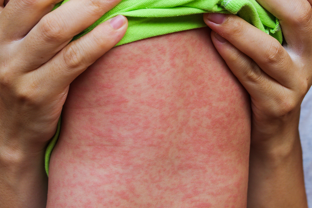 A child with a rash caused by the measles virus. A child with a rash caused by the measles virus.